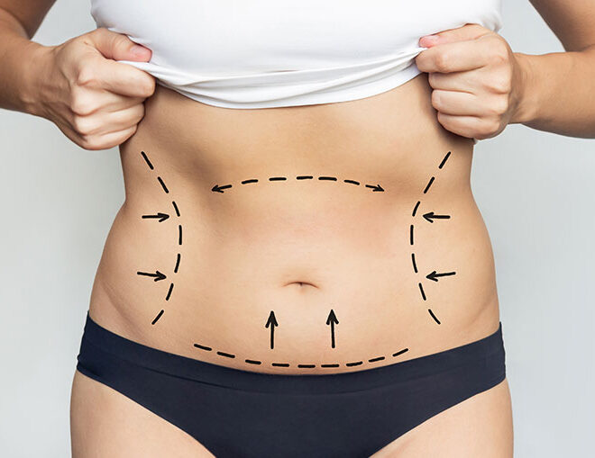 The Cost of a Mini Tummy Tuck in Dubai: Affordable Body Contouring Options