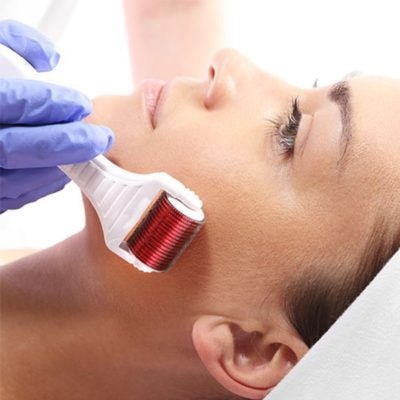 Derma Roller Treatment In Islamabad