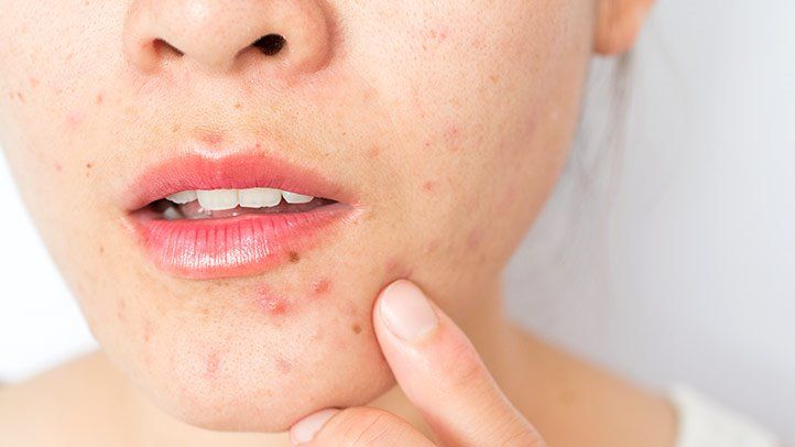 Does Acne Treatment Work for Blackheads?