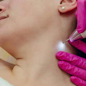 Dynamic Aesthetic – Quick & Painless Skin Tag Removal