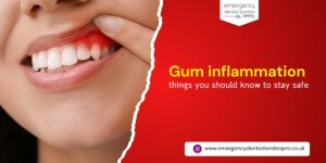 Gum inflammation – things you should know to stay safe