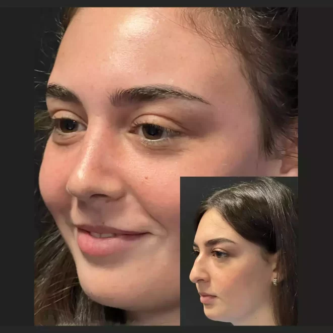 Latest Trends in Nose Surgery in Dubai: 2025 Edition