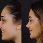 Trusted Septoplasty Solutions by the Best Doctors in Dubai