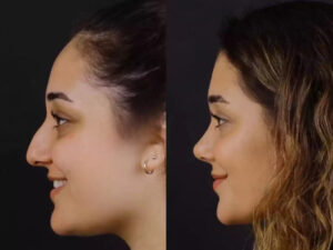 Trusted Septoplasty Solutions by the Best Doctors in Dubai