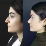 Nose Deviated Septum Surgery in Dubai: What to Expect Before and After