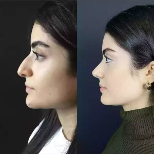 Nose Deviated Septum Surgery in Dubai: What to Expect Before and After
