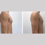International Patients Guide to Finding the Best Gynecomastia Surgeons in dubai