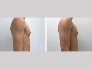International Patients Guide to Finding the Best Gynecomastia Surgeons in dubai