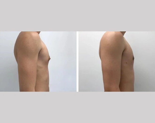 International Patients Guide to Finding the Best Gynecomastia Surgeons in dubai