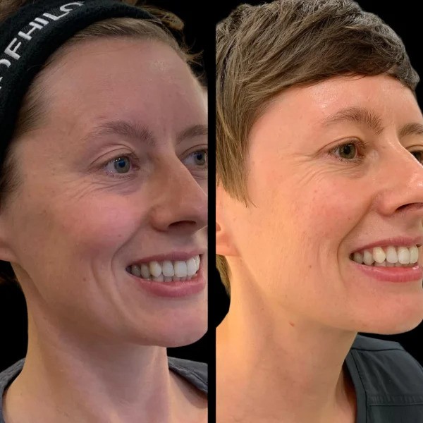 What to Expect After Profhilo: Recovery Tips from the Best Aesthetic Clinic in Dubai