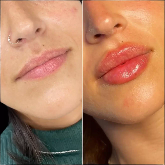 Russian Lip Fillers for Thin Lips: Why the Best Doctors in Dubai This Technique