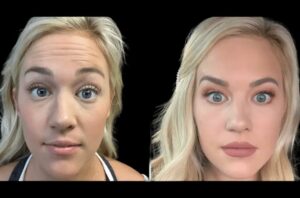 First-Timer’s Guide to Botox in Dubai: What to Expect and Ask Before You Book