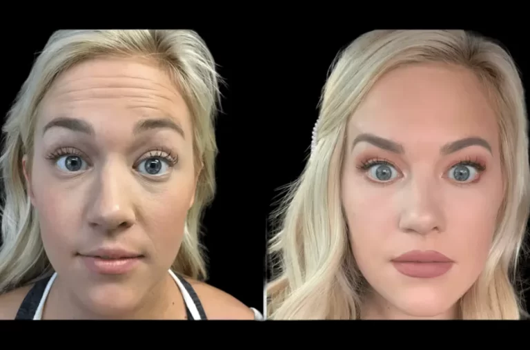 What Makes Botox at the Best Aesthetic Clinic in dubai Truly Exceptional