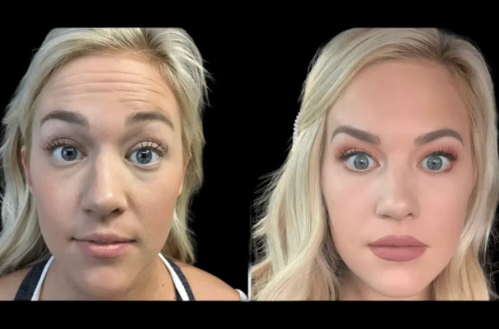 Botox in dubai