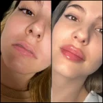 Best Aesthetic Clinic in Dubai for Fillers: Non-Surgical Facelift Options