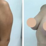 The Role of Patient Care in Choosing the Best Breast Lift Surgeons in dubai