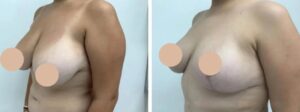 The Role of Patient Care in Choosing the Best Breast Lift Surgeons in dubai