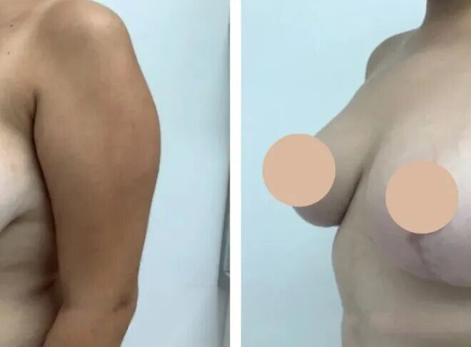 The Role of Patient Care in Choosing the Best Breast Lift Surgeons in dubai