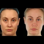 How Under Eye Fillers Help Improve Eye Area Skin with the Best Doctors in Dubai