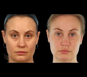 How Under Eye Fillers Help Improve Eye Area Skin with the Best Doctors in Dubai
