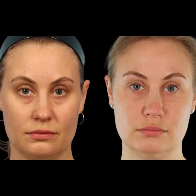 How Under Eye Fillers Help Improve Eye Area Skin with the Best Doctors in Dubai