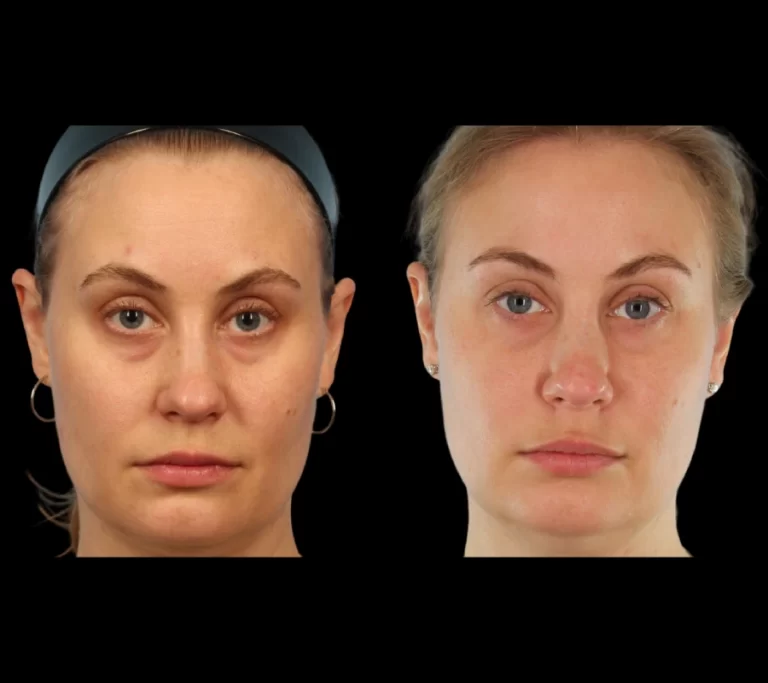 How Under Eye Fillers Help Improve Eye Area Skin with the Best Doctors in Dubai