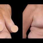 How the Best Breast Reduction Surgeons in dubai Can Help You Achieve Your Ideal Look
