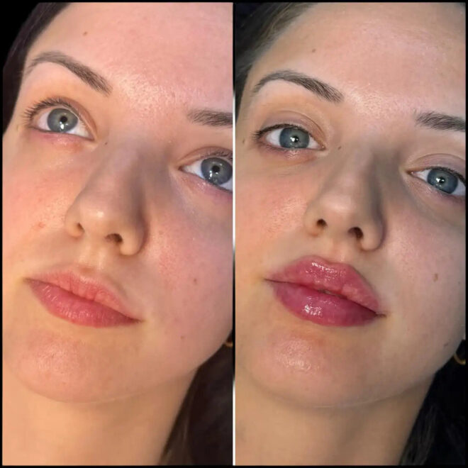 Best Plastic Surgeons in dubai for Face Fillers: Creating Natural, Youthful Results