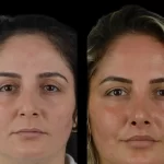 Cheek Fillers: Why the Best Doctors in Dubai Are Experts at What They Do