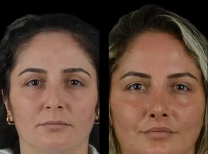 Cheek Fillers: Why the Best Doctors in Dubai Are Experts at What They Do
