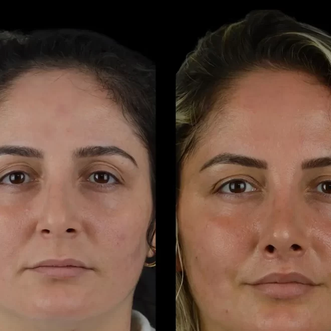 Cheek Fillers: Why the Best Doctors in Dubai Are Experts at What They Do