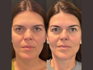 Exploring the Different Types of Thread Lifts Offered by the Best Doctors in Dubai