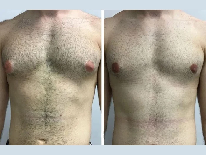 Real Patient Stories: Living with and Treating Gynecomastia in Dubai