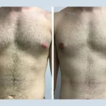 Patient Safety Tips from the Best Gynecomastia Surgeons in Dubai