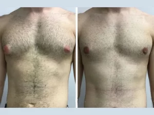 Patient Safety Tips from the Best Gynecomastia Surgeons in Dubai