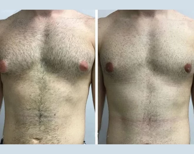 Patient Safety Tips from the Best Gynecomastia Surgeons in Dubai