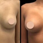Why Breast Augmentation Surgery with the Best Breast Augmentation Surgeons in Dubai Is Worth the Investment