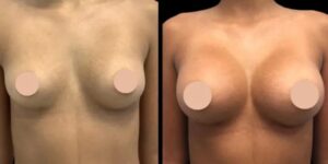 Why Breast Augmentation Surgery with the Best Breast Augmentation Surgeons in Dubai Is Worth the Investment