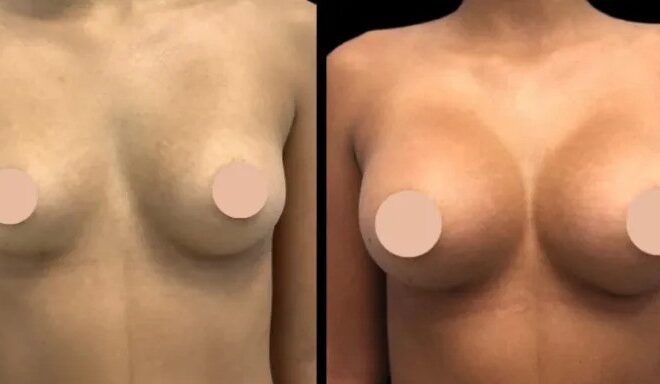 Why Breast Augmentation Surgery with the Best Breast Augmentation Surgeons in Dubai Is Worth the Investment