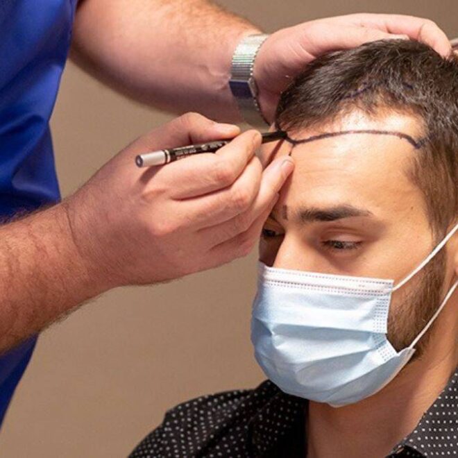 Why Board Certification Matters for Hair Transplants in Islamabad
