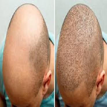 زراعة الشعر في دبي: استعد لاستعادة ثقتك بنفسك