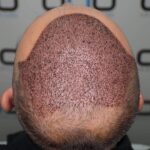 Can women undergo hair transplant surgery?