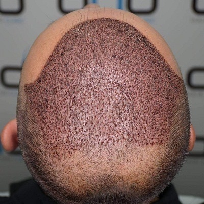 Can women undergo hair transplant surgery?