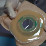 The Stress and Triumphs of Colon Transplantation
