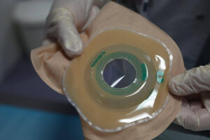 The Stress and Triumphs of Colon Transplantation