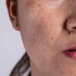 Is Acne Scar Treatment Better Than Others Procedure?