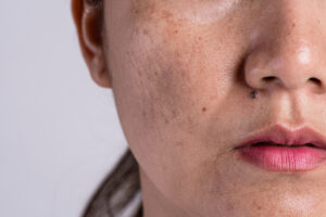 Is Acne Scar Treatment Better Than Others Procedure?