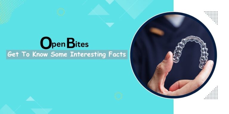 Open Bites: Get To Know Some Interesting Facts