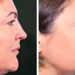Is Profhilo Right for You Insights from the Best Aesthetic Clinic in Dubai
