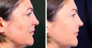 Is Profhilo Right for You Insights from the Best Aesthetic Clinic in Dubai